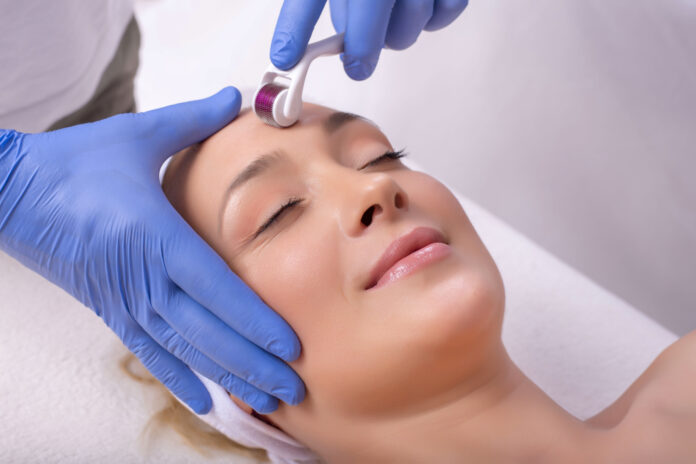 microneedling