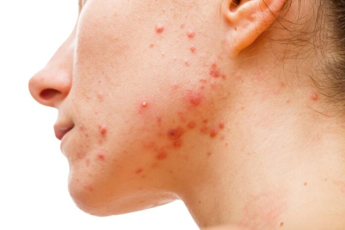 hormonal cystic acne