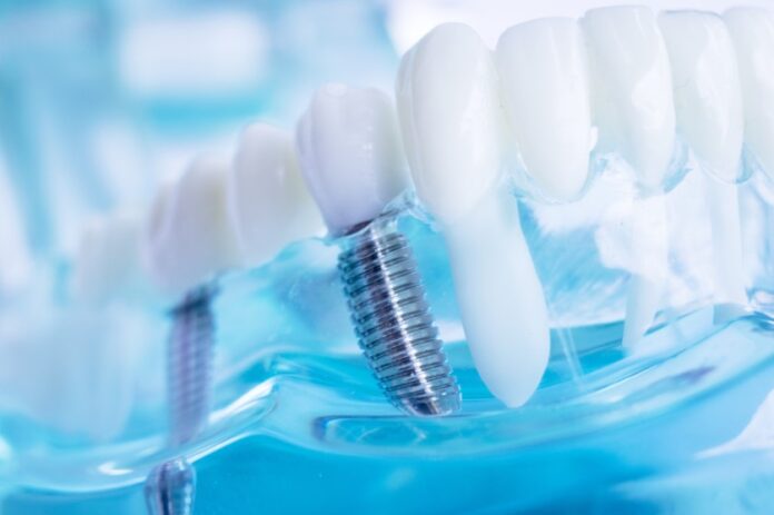 types of dental implants