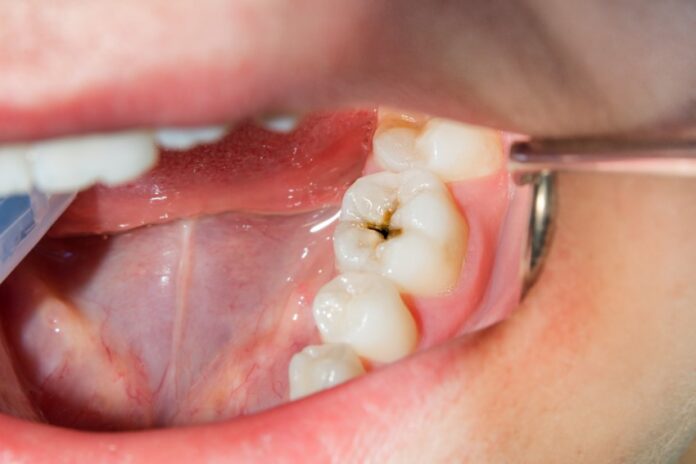 common dental problems