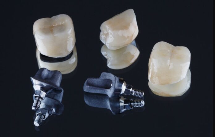 cost of dental implants