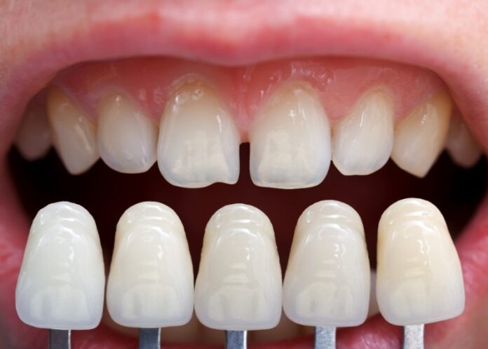 cost of dental veneers