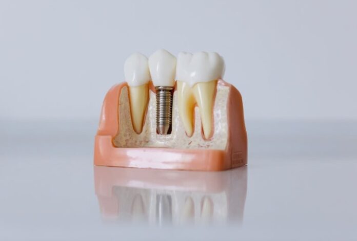 type of dental implants
