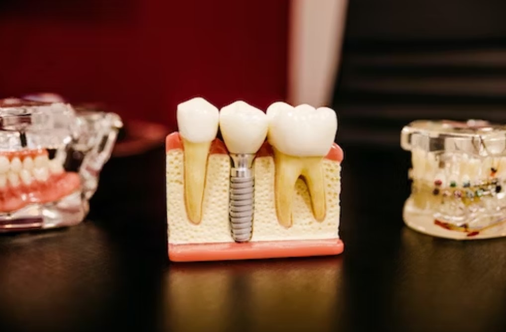 Solutions for Tooth Loss